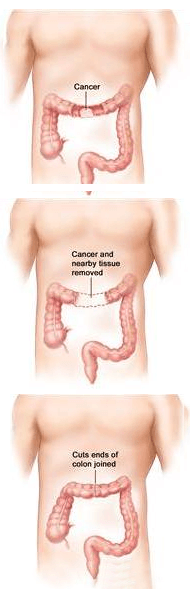 Laparoscopic Colon Resection for Cancer