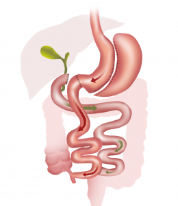 duodenal