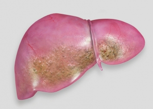 Fatty Liver Disease