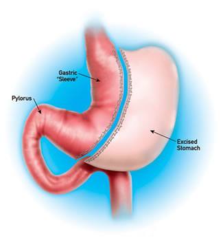 Laparoscopic Sleeve Gastrectomy