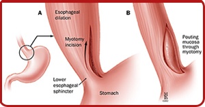 Heller Myotomy