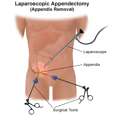 Laparoscopic Appendectomy