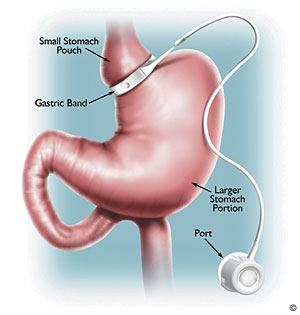 Laparoscopic Adjustable Gastric Banding