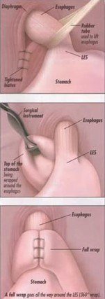 Laparoscopic Nissen Fundoplication