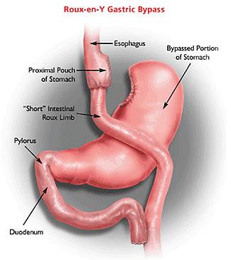 Laparoscopic Gastric Bypass