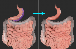 Revision Sleeve Surgery