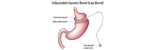 Are you qualified for a lap band surgery?