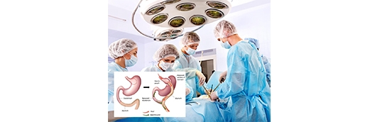 How Does Bariatric Surgery Work?