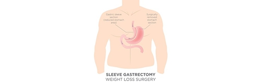 How much weight can I lose from Gastric Sleeve Surgery?