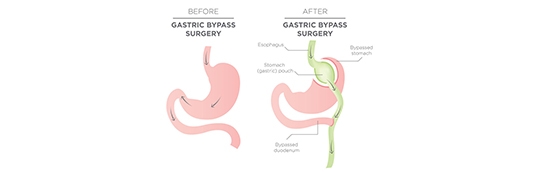 What Happens After Gastric Bypass Surgery?