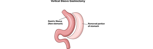 What is Gastric Sleeve Surgery?