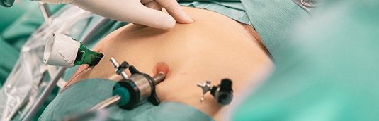 What Is Minimally Invasive Weight Loss Surgery and How Does It Help Long Island, Port Jeff...