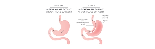 What to expect before and during gastric bypass surgery?