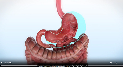 Endoscopic Sleeve Gastroplasty