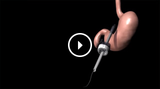 Laparoscopic Gastric Bypass